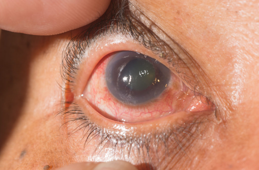 Close up eye with close angle glaucoma.