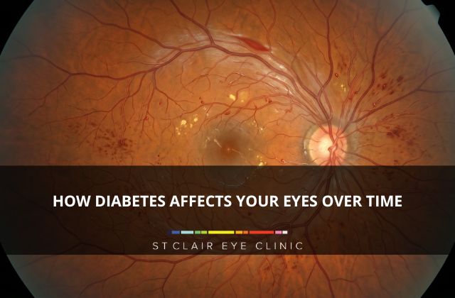 Close-up retinal scan showing diabetic eye damage and blood vessel changes caused by diabetes over time.